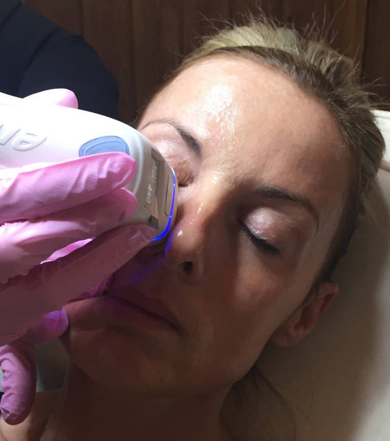 Emerge non-ablative fractional laser skin treatment