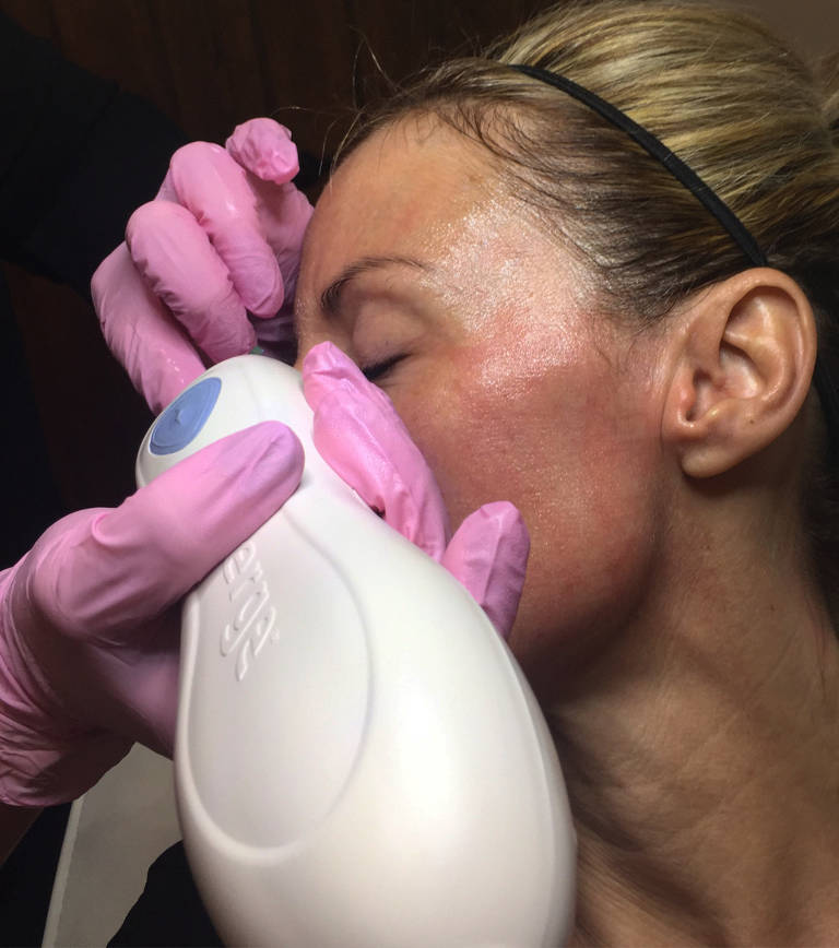 Emerge non-ablative fractional laser skin treatment