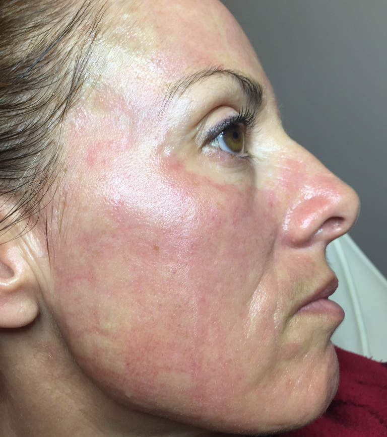 Immediately after the treatment