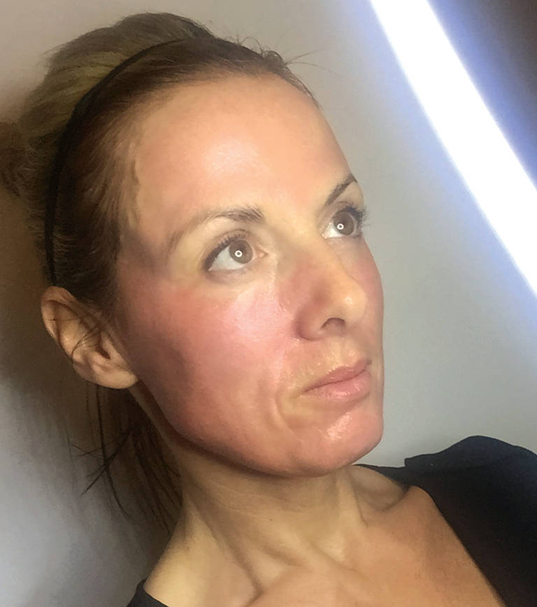 1 hour after treatment