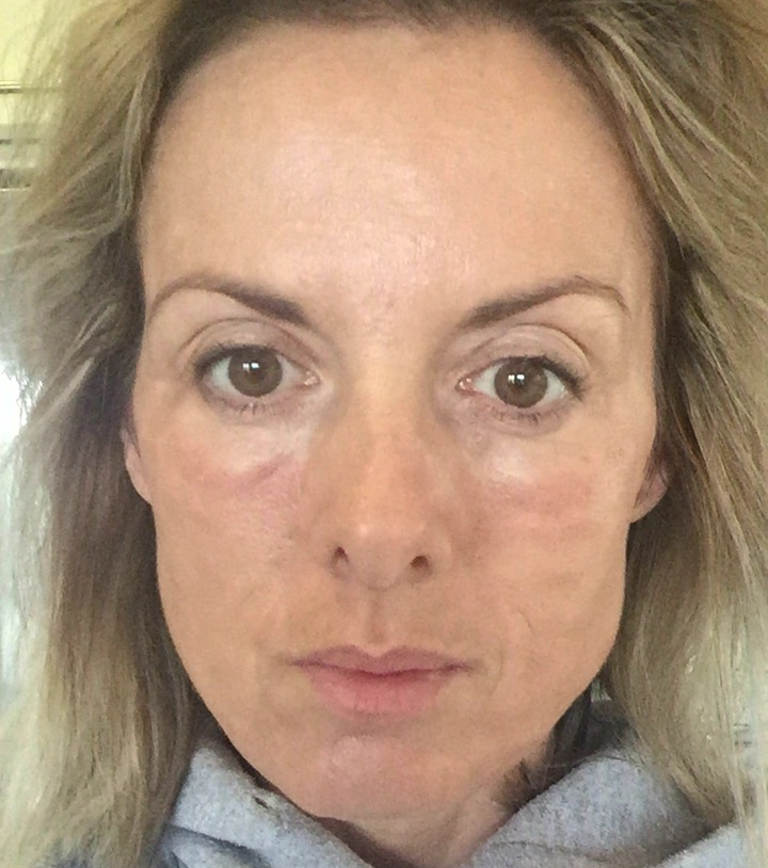 Morning after treatment